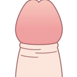 カントン包茎