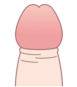 カントン包茎