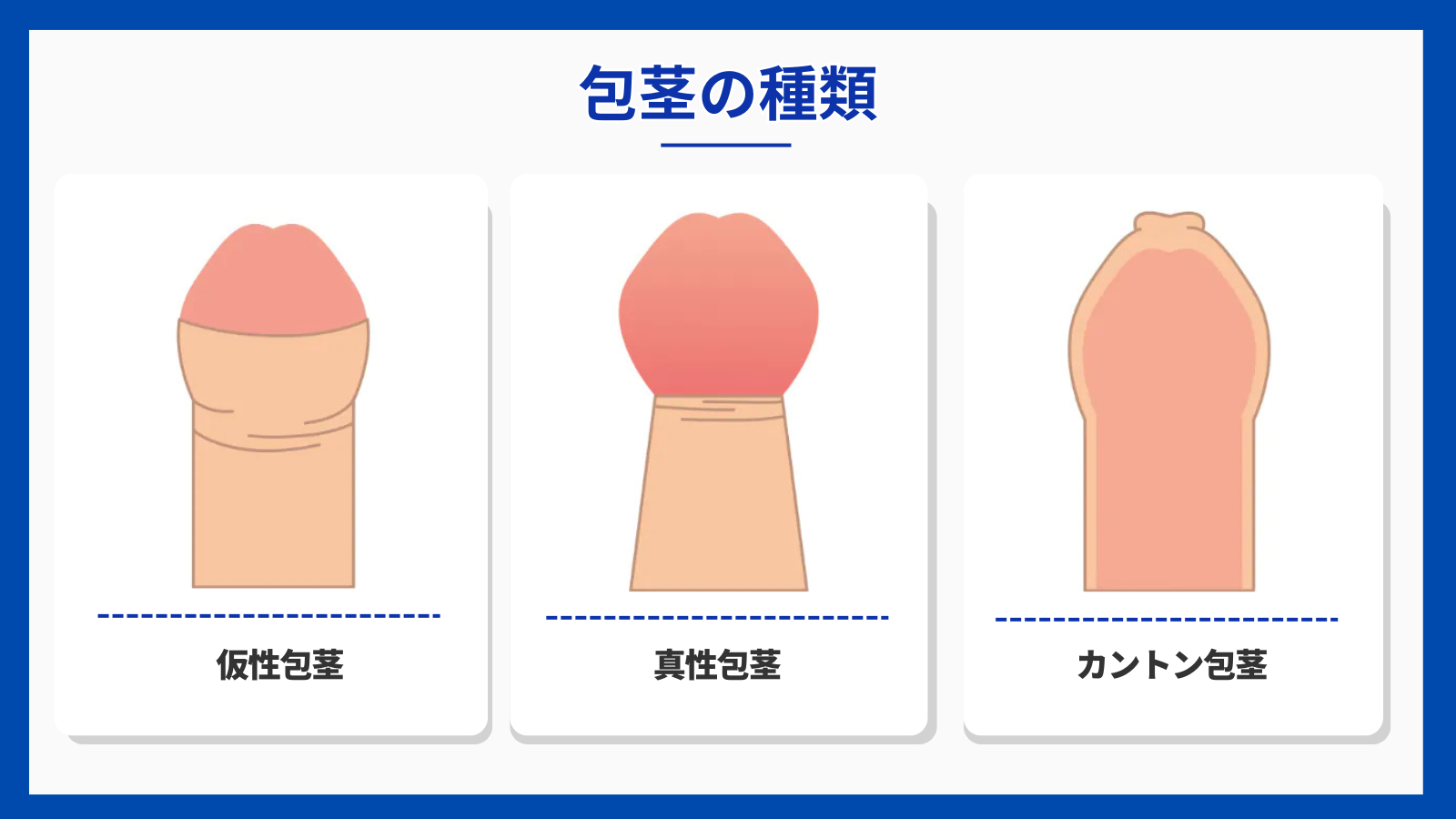 包茎の種類