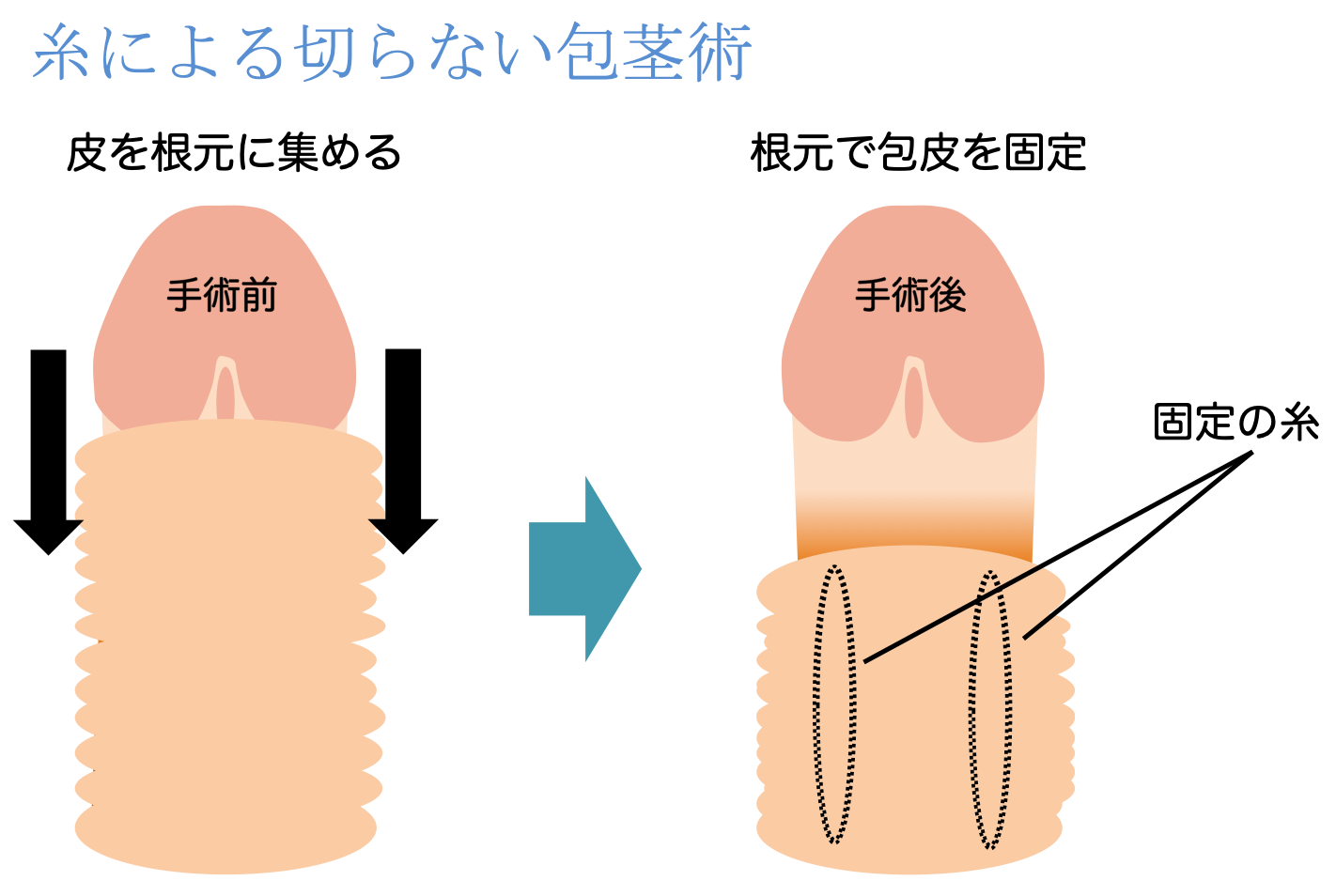 切らない包茎術