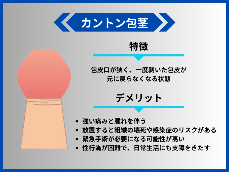 カントン包茎