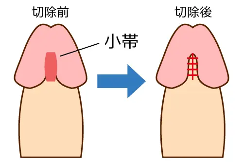 包茎
