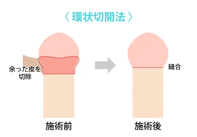 環状切開
