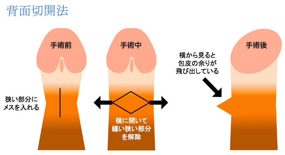 背面切開