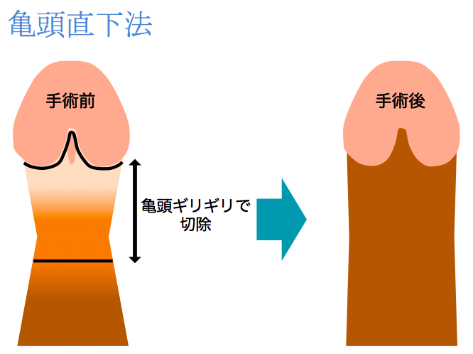 亀頭直下