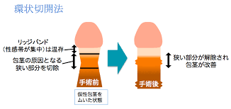 環状切開法