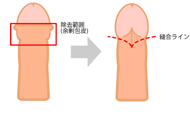 背面切開法
